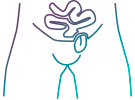 ico_ac_site_hernia_inguinal_01